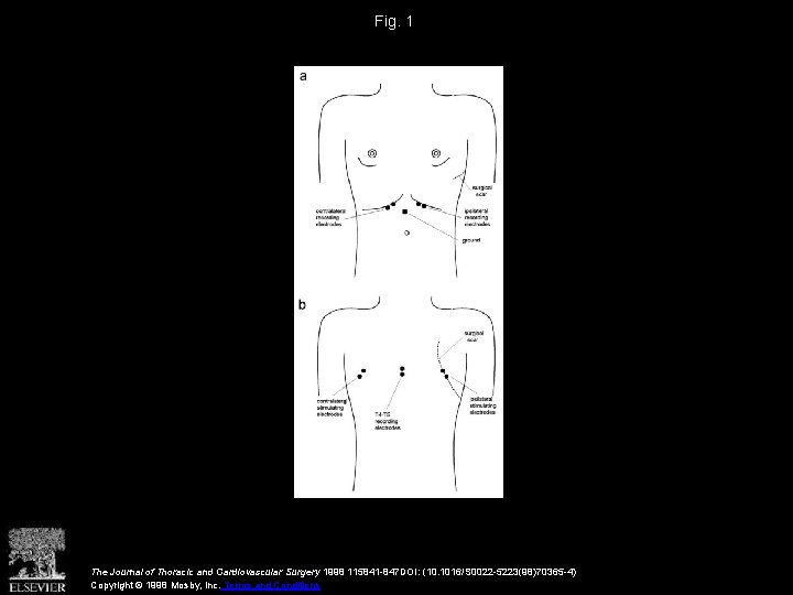 Fig. 1 The Journal of Thoracic and Cardiovascular Surgery 1998 115841 -847 DOI: (10.