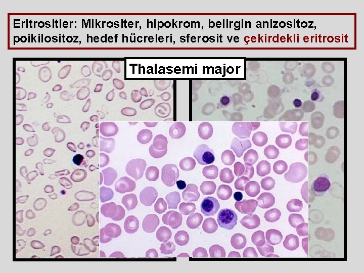 Eritrositler: Mikrositer, hipokrom, belirgin anizositoz, poikilositoz, hedef hücreleri, sferosit ve çekirdekli eritrosit Thalasemi major Eritrositler: Mikrositer, hipokrom, belirgin anizositoz, poikilositoz, hedef hücreleri, sferosit ve çekirdekli eritrosit Thalasemi major