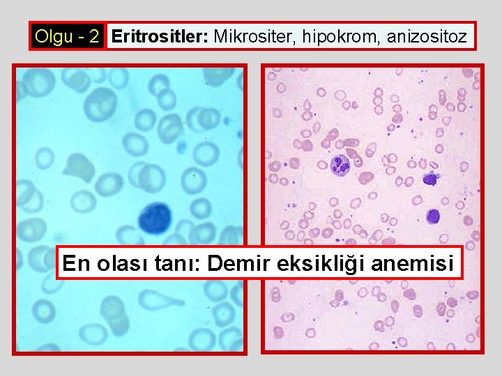 Olgu - 2 Eritrositler: Mikrositer, hipokrom, anizositoz En olası tanı: Demir eksikliği anemisi Olgu - 2 Eritrositler: Mikrositer, hipokrom, anizositoz En olası tanı: Demir eksikliği anemisi