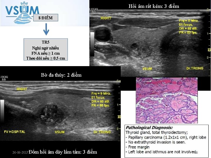 Hồi âm rất kém: 3 điểm 8 ĐIỂM TR 5 Nghi ngờ nhiều FNA Hồi âm rất kém: 3 điểm 8 ĐIỂM TR 5 Nghi ngờ nhiều FNA