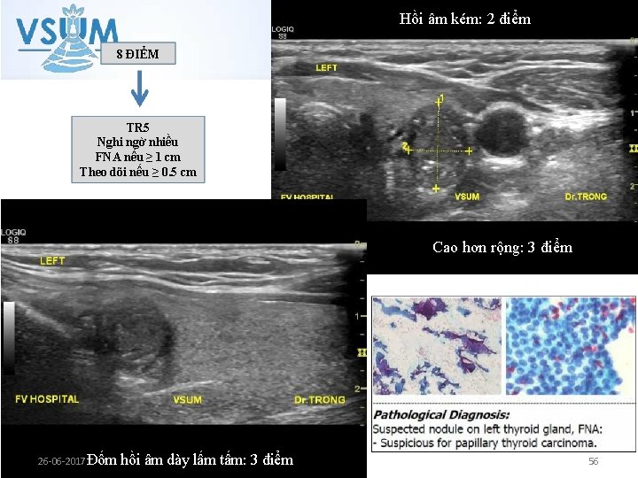 Hồi âm kém: 2 điểm 8 ĐIỂM TR 5 Nghi ngờ nhiều FNA nếu Hồi âm kém: 2 điểm 8 ĐIỂM TR 5 Nghi ngờ nhiều FNA nếu