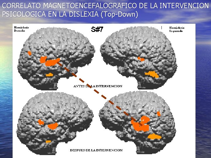 CORRELATO MAGNETOENCEFALOGRAFICO DE LA INTERVENCION PSICOLOGICA EN LA DISLEXIA (Top-Down) 