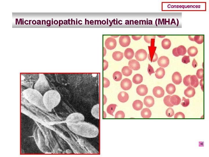Consequences Microangiopathic hemolytic anemia (MHA) 