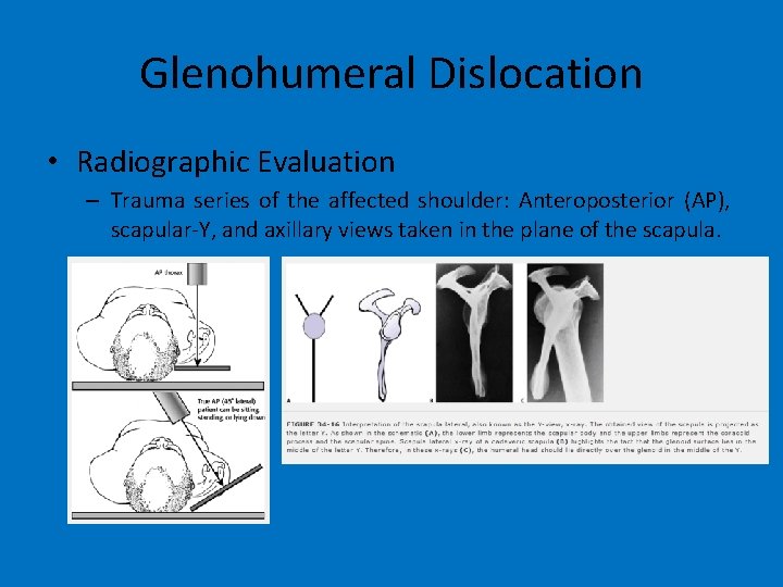 Glenohumeral Dislocation • Radiographic Evaluation – Trauma series of the affected shoulder: Anteroposterior (AP),