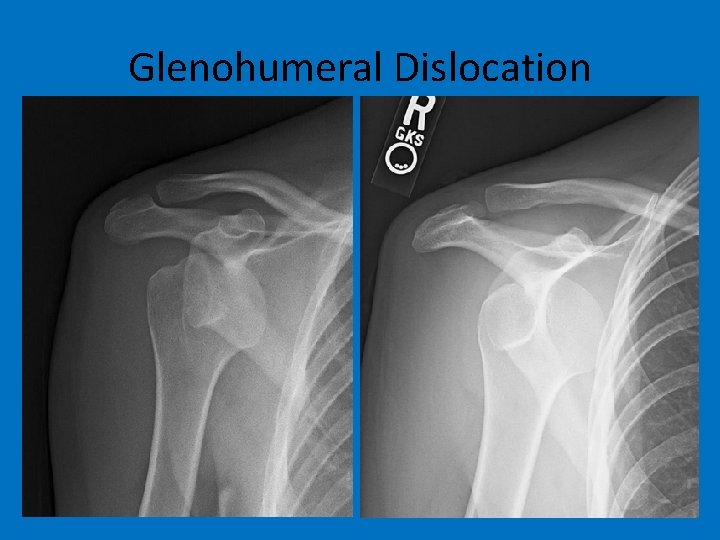 Glenohumeral Dislocation 