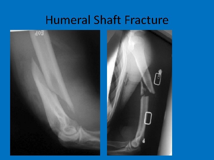 Humeral Shaft Fracture 