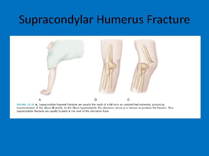 Supracondylar Humerus Fracture 