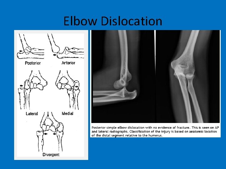 Elbow Dislocation 