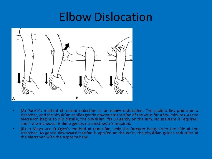 Elbow Dislocation • • (A) Parvin’s method of closed reduction of an elbow dislocation.