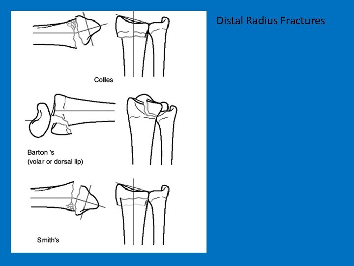 Distal Radius Fractures 