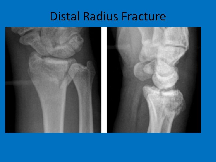 Distal Radius Fracture 