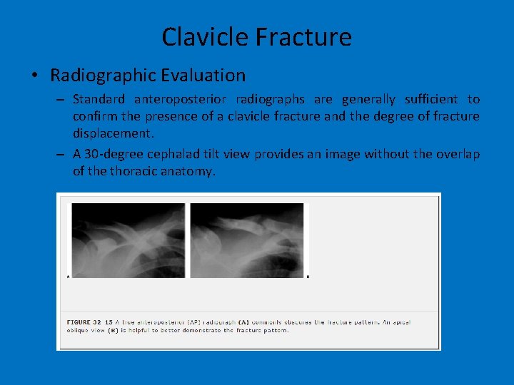 Clavicle Fracture • Radiographic Evaluation – Standard anteroposterior radiographs are generally sufficient to confirm