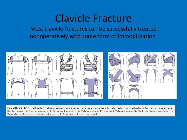 Clavicle Fracture Most clavicle fractures can be successfully treated nonoperatively with some form of