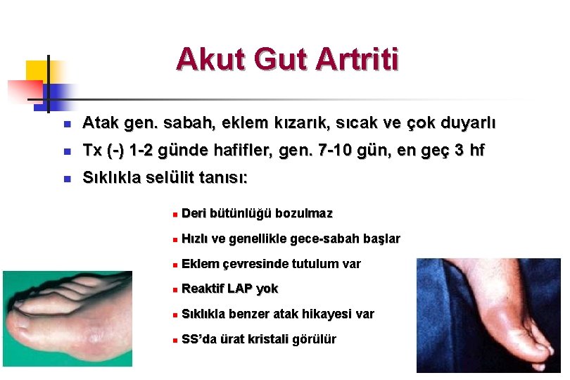 Akut Gut Artriti n Atak gen. sabah, eklem kızarık, sıcak ve çok duyarlı n