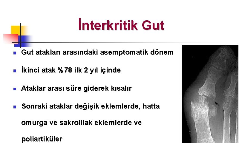 İnterkritik Gut n Gut atakları arasındaki asemptomatik dönem n İkinci atak %78 ilk 2