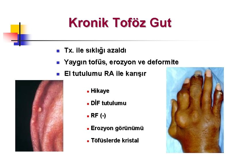 Kronik Toföz Gut n Tx. ile sıklığı azaldı n Yaygın tofüs, erozyon ve deformite