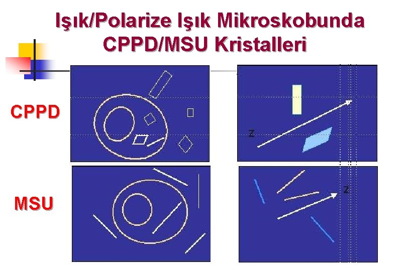 Işık/Polarize Işık Mikroskobunda CPPD/MSU Kristalleri CPPD MSU 