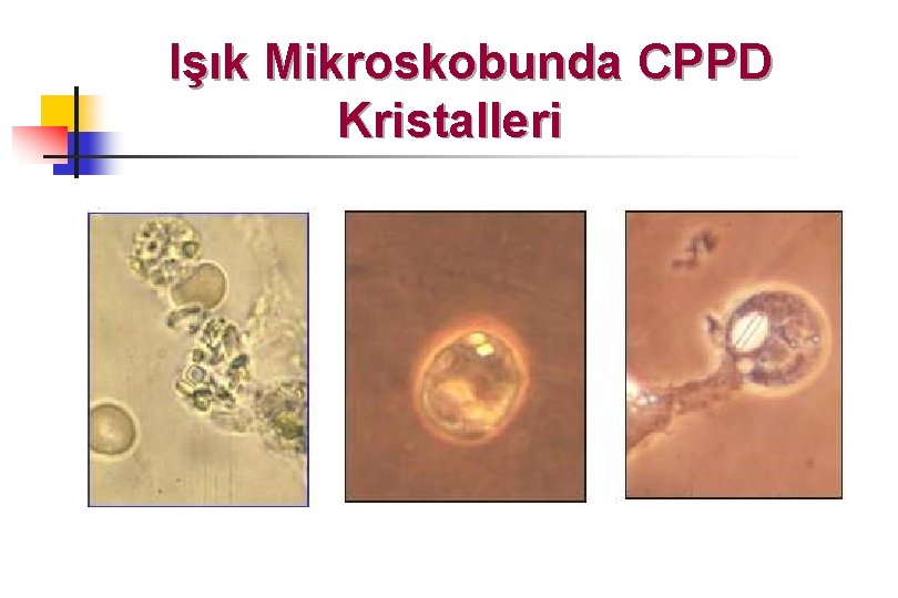 Işık Mikroskobunda CPPD Kristalleri 