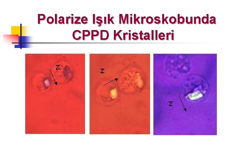 Polarize Işık Mikroskobunda CPPD Kristalleri 