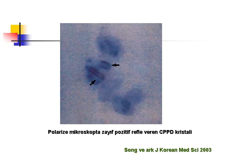 Polarize mikroskopta zayıf pozitif refle veren CPPD kristali Song ve ark J Korean Med