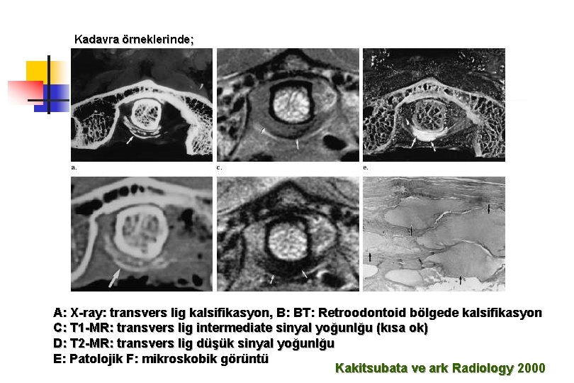 Kadavra örneklerinde; A: X-ray: transvers lig kalsifikasyon, B: BT: Retroodontoid bölgede kalsifikasyon C: T