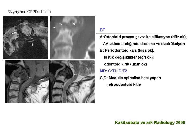 56 yaşında CPPD’li hasta BT A: Odontoid proçes çevre kalsifikasyon (düz ok), AA eklem
