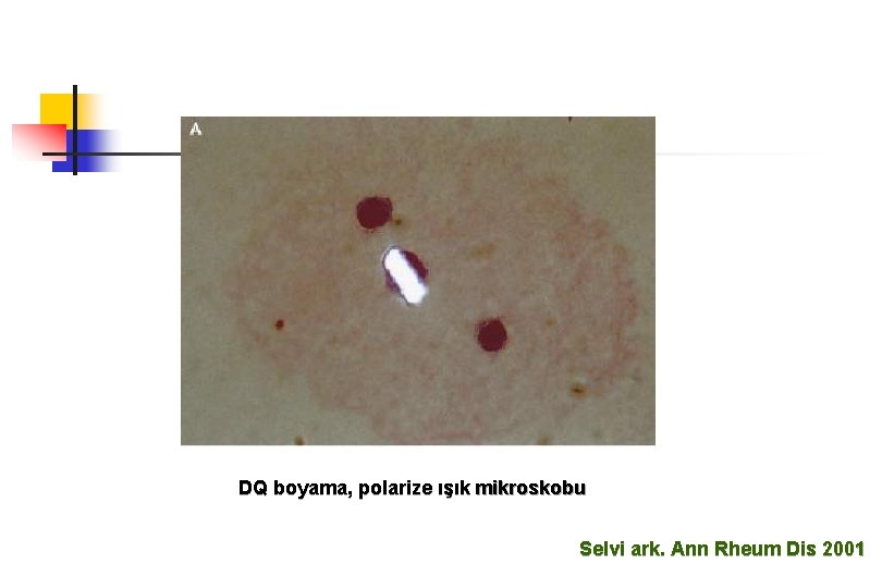 DQ boyama, polarize ışık mikroskobu Selvi ark. Ann Rheum Dis 2001 