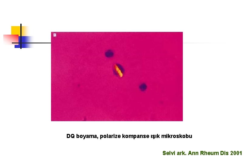 DQ boyama, polarize kompanse ışık mikroskobu Selvi ark. Ann Rheum Dis 2001 