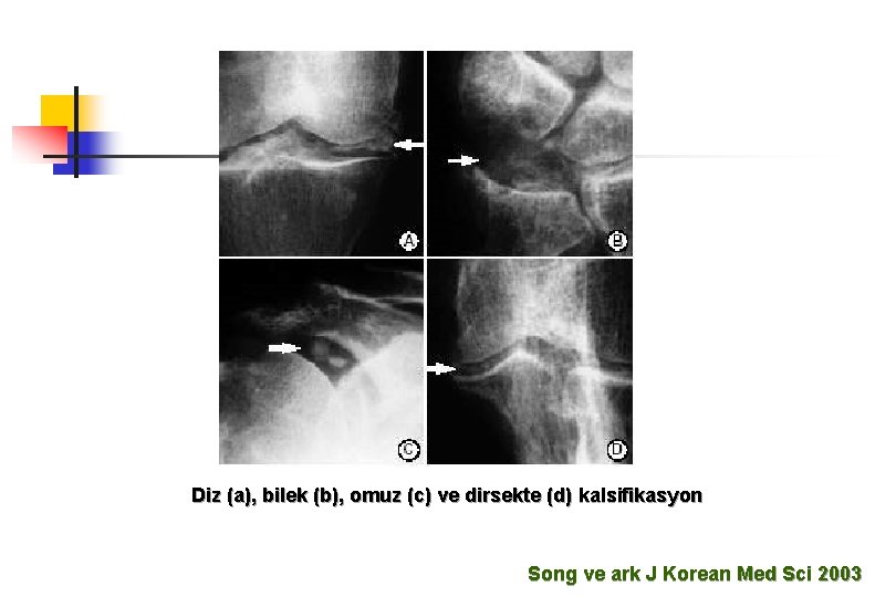 Diz (a), bilek (b), omuz (c) ve dirsekte (d) kalsifikasyon Song ve ark J