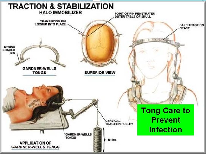 Tong Care to Prevent Infection 6 