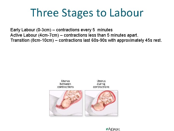 Three Stages to Labour Early Labour (0 -3 cm) – contractions every 5 minutes