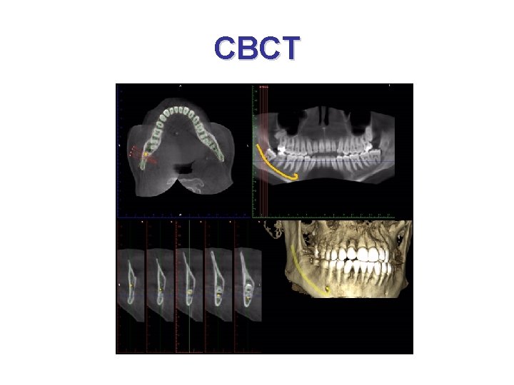 CBCT 