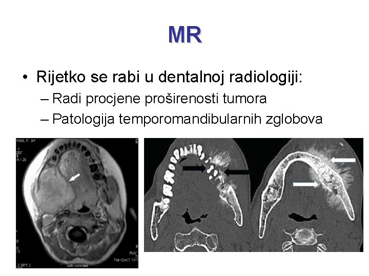 MR • Rijetko se rabi u dentalnoj radiologiji: – Radi procjene proširenosti tumora –