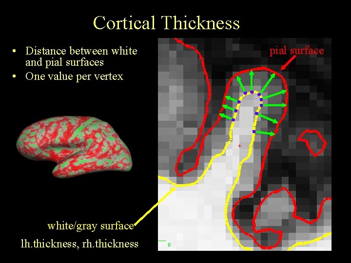 Cortical Thickness • Distance between white and pial surfaces • One value per vertex