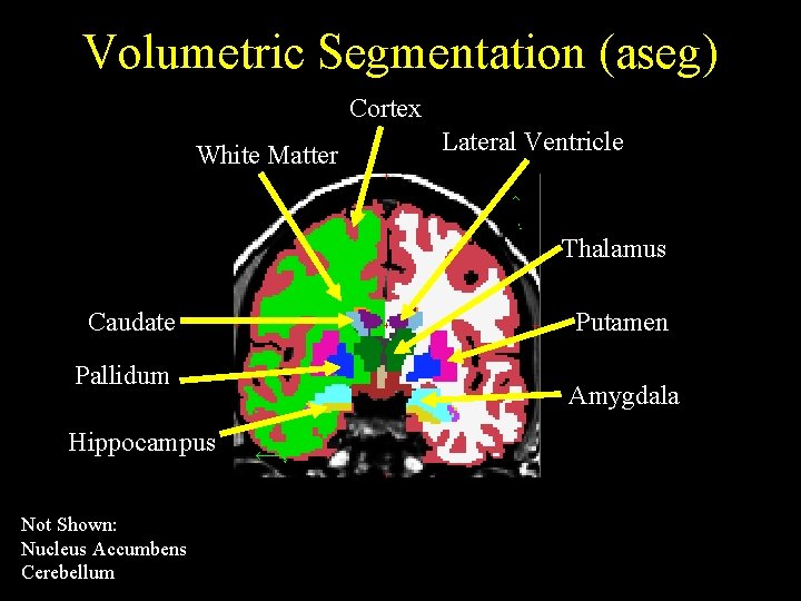 Volumetric Segmentation (aseg) Cortex White Matter Lateral Ventricle Thalamus Caudate Pallidum Hippocampus Not Shown: