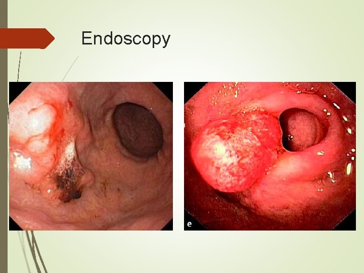 Endoscopy 