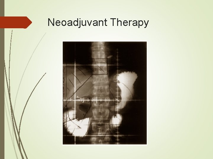 Neoadjuvant Therapy 