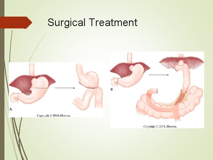 Surgical Treatment 