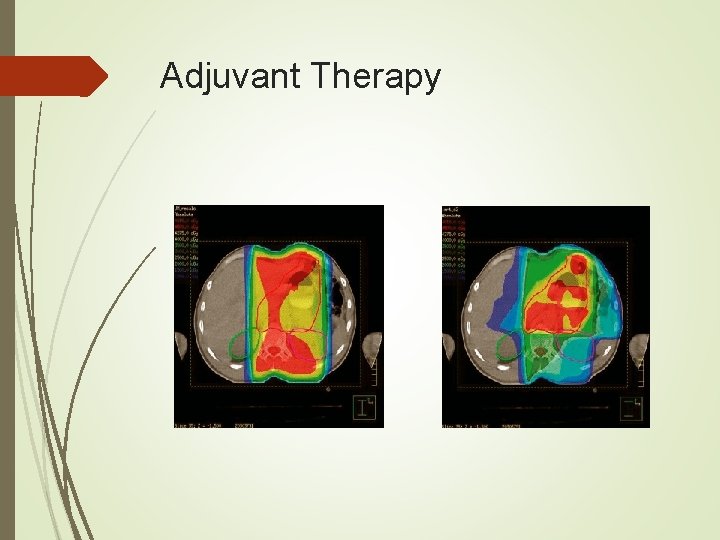 Adjuvant Therapy 