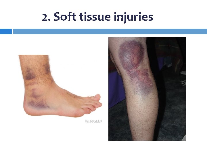 2. Soft tissue injuries 