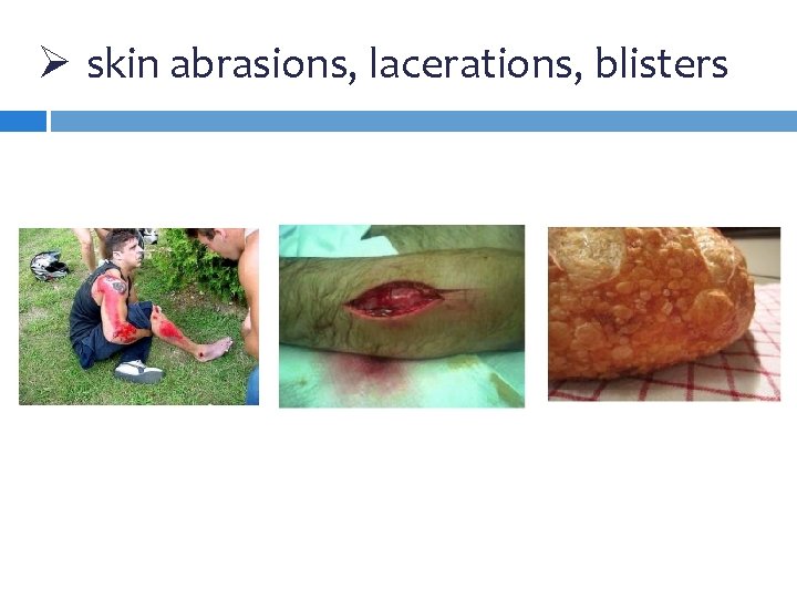 Ø skin abrasions, lacerations, blisters 