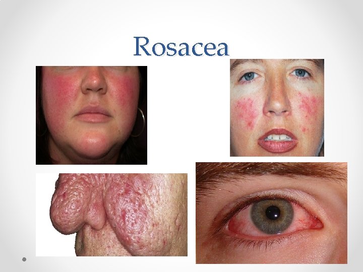 Rosacea 