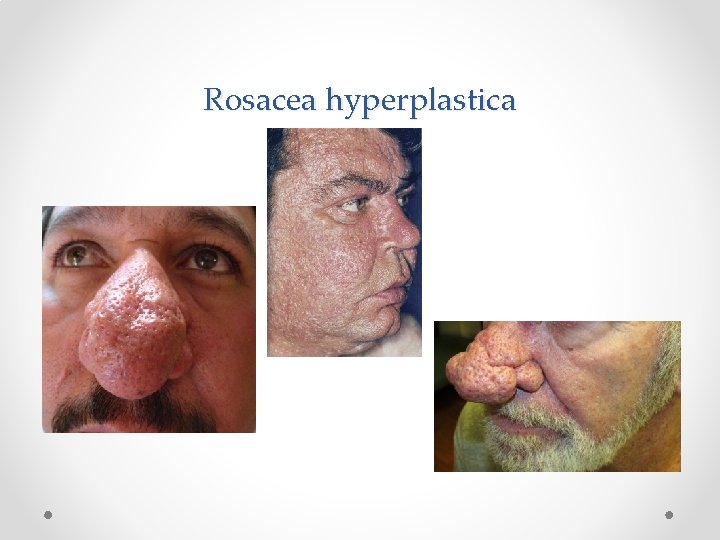 Rosacea hyperplastica 