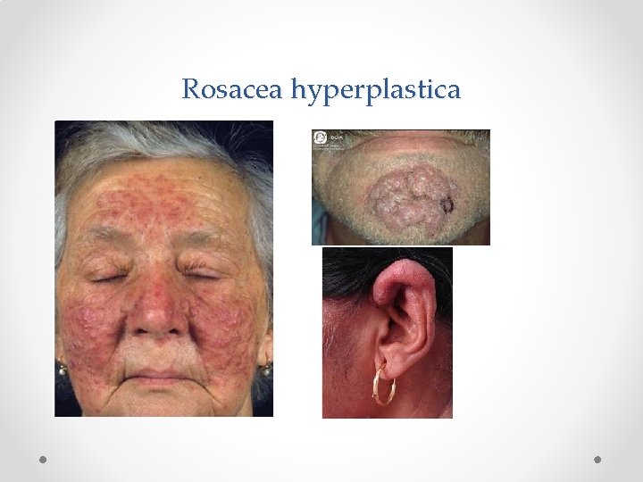 Rosacea hyperplastica 