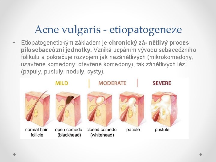 Acne vulgaris - etiopatogeneze • Etiopatogenetickým základem je chronický zá- nětlivý proces pilosebaceózní jednotky.