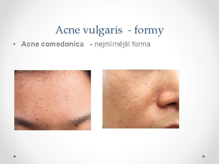 Acne vulgaris - formy • Acne comedonica - nejmírnější forma 