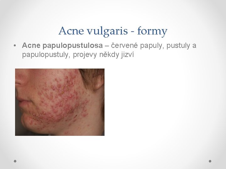 Acne vulgaris - formy • Acne papulopustulosa – červené papuly, pustuly a papulopustuly, projevy