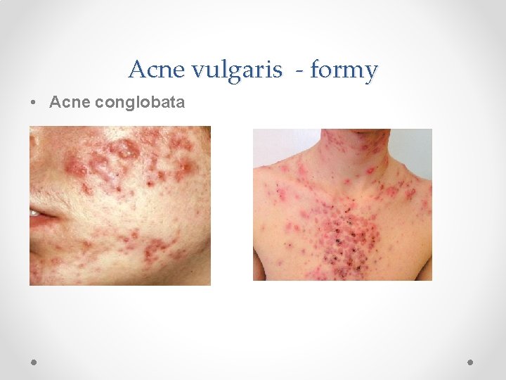 Acne vulgaris - formy • Acne conglobata 