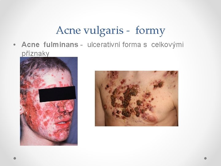 Acne vulgaris - formy • Acne fulminans - ulcerativní forma s celkovými příznaky 