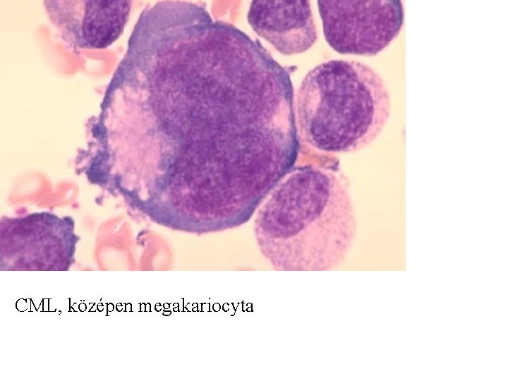 CML, középen megakariocyta 